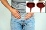 Bladder Cancer, Bladder Cancer, why is bladder cancer common in men, Gender bias