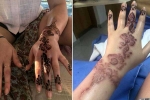 black henna side effects, black henna side effects, henna tattoo cause aussie woman to almost lose her hand, Blisters