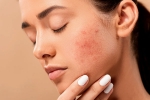 skin care products, pimples, 10 ways to get rid of pimples at home, Acne